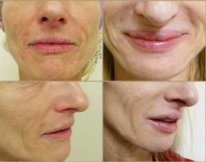 Los-Angeles-Juvederm-1
