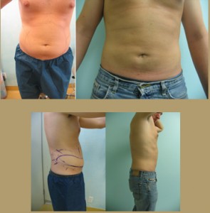 liposuction