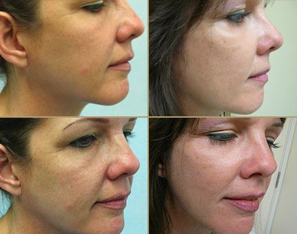 silhouette  face lift