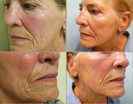 silhouette  face lift