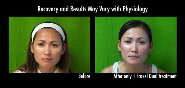 Los Angeles patient before and after laser rejuvenation with Fraxel laser
