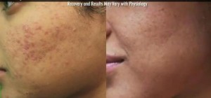 Los Angeles acne- Clearing existing acne is important for successful acne scar removal results. This can be achieved with the Spectra laser