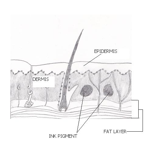 ... laser tattoo removal- diagram of tattoo ink pigment in the dermis