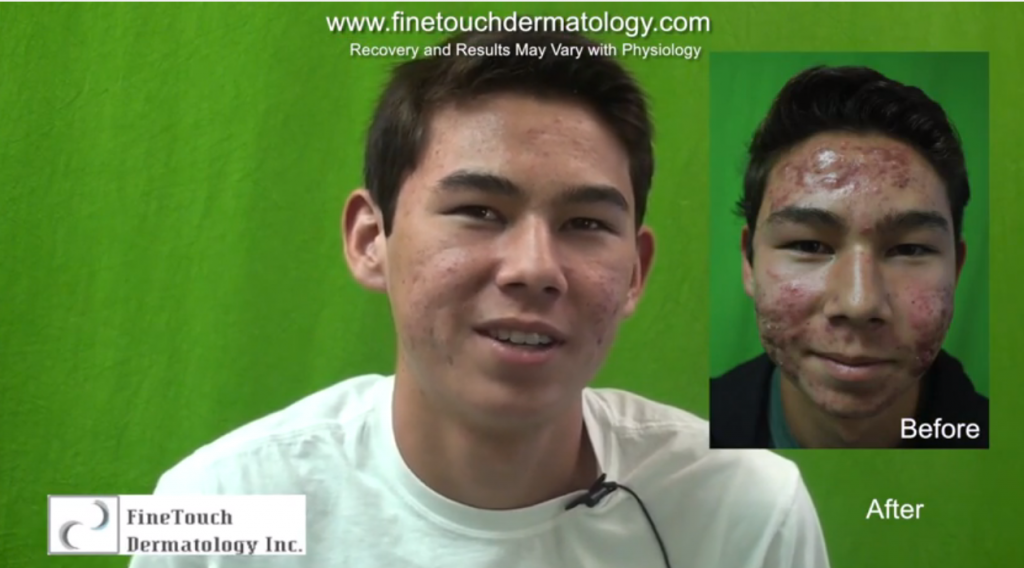 Improvements For Severe Acne and Scars