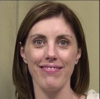 Patient With Laugh Lines Around Mouth