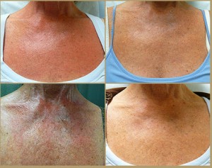 Dermatologist Treatment for Poikiloderma| Los Angeles Patient Dermatologist Treatment for Poikiloderma| Los Angeles Patient