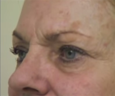 Age Spots| Example on a Patient