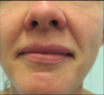 Patient With Deep Nasolabial Folds