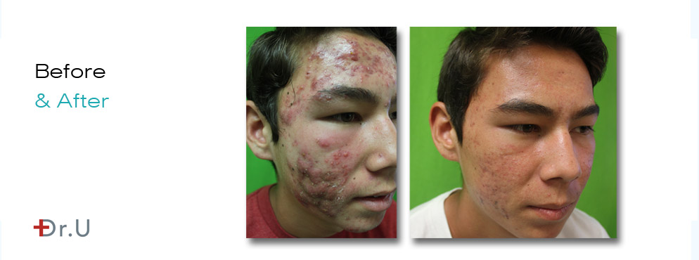 Severe Acne|Patient Before & After Treatment