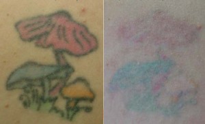 tattoo removal image