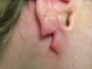 Example of Split Earlobe