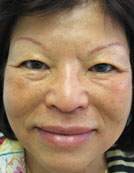 Los Angeles patient after saggy skin and jowl correction with the Silhouette lift