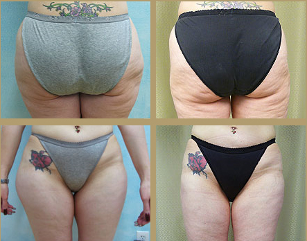 Front and Back Views of Liposuction Results in Los Angeles Patient