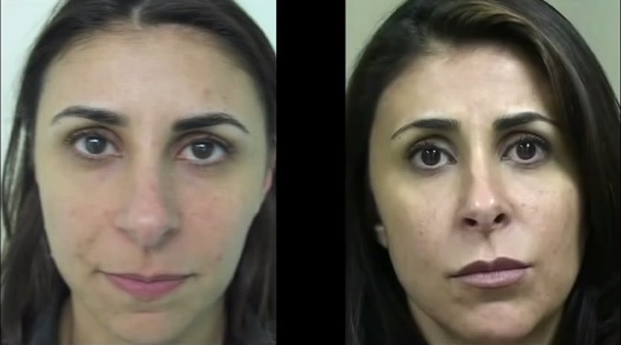 Results of Dermal Filler Treatment For Laugh Lines