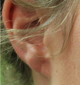 Split Earlobe Repair Results - Los Angeles Patient