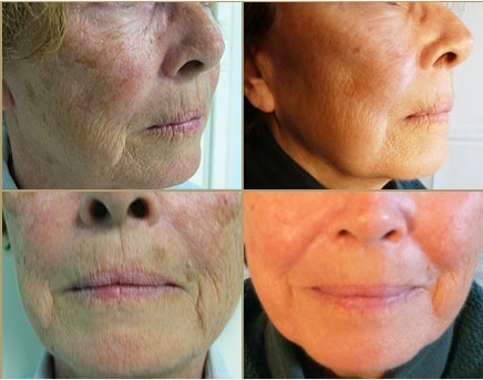 Patient Before and After Portrait Plasma