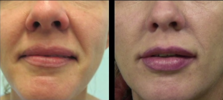 Patient Before & After Silhouette Lift