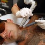 Laser Tattoo Removal | Large Design
