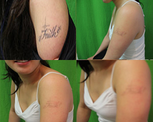 if you desire laser tattoo removal and know that your tattoo is over a ...