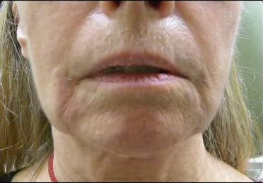 Patient Before Radiesse Treatment For Wrinkles