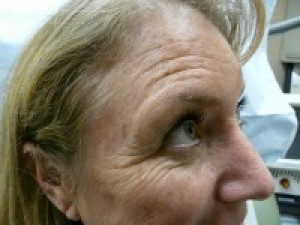 Crows Feet Lines| Photo of Patient - Side View