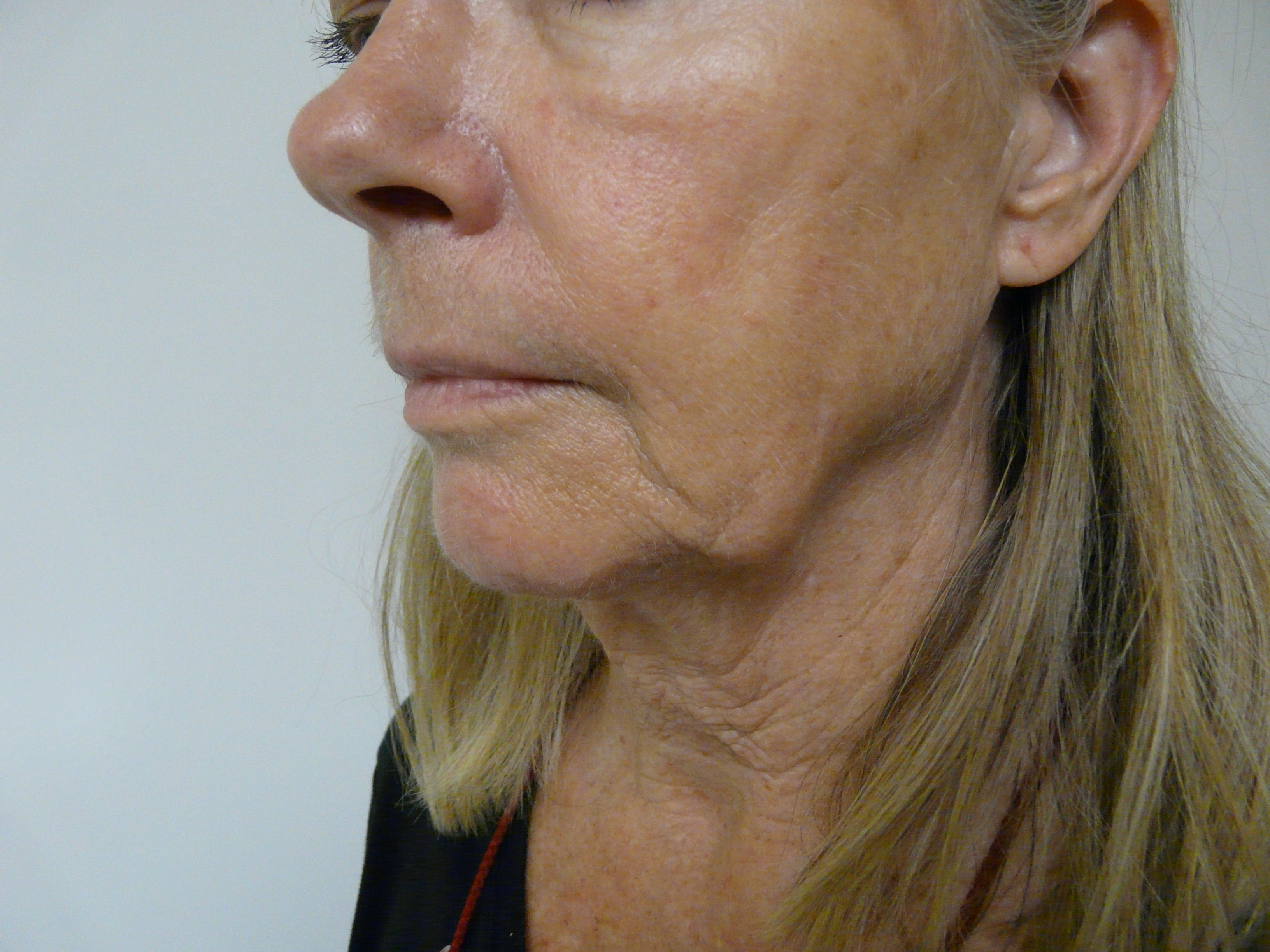 Non-Surgical Solution For Jowls on Jawline| Before Radiesse Treatment