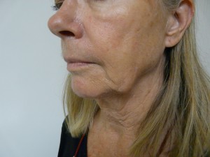 Formation of Jowl|Patient Before Her Radiesse Treatment