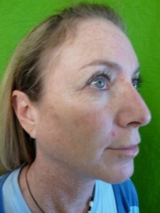 Example of botox patient after