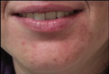 Acne Scarring| New Hope With Lasers