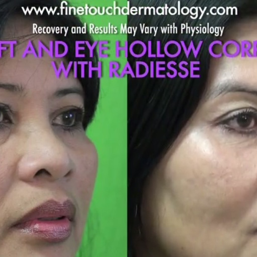 Cheek Lift Without Surgery| Radiesse