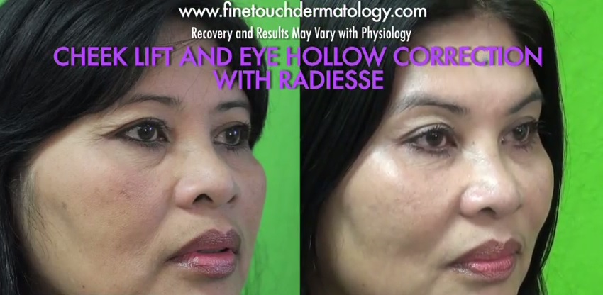 higher cheeks| non-surgical treatment with Radiesse