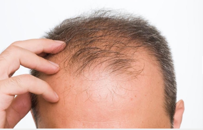 Causes of Hair Loss