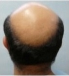 Pattern Baldness in Male Patient