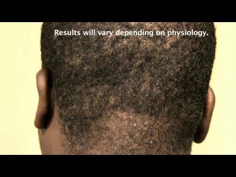 acne akn keloidalis nuchae should