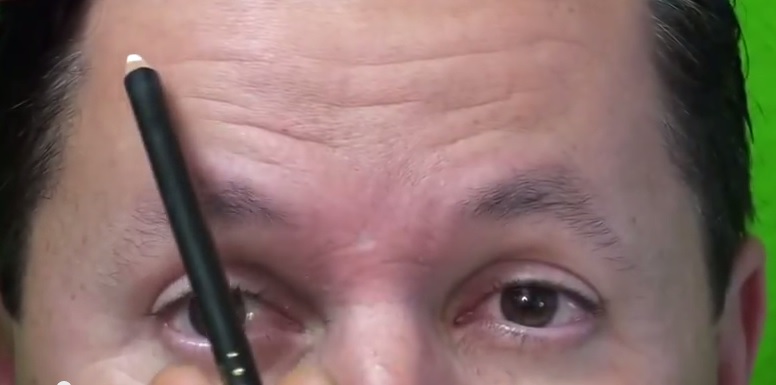 Forehead Wrinkles Before Dysport Injections