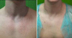 Rosacea Treatment Results| Vbeam For Chest Redness