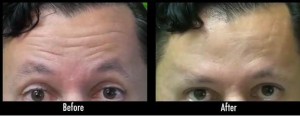 Los Angeles male patient before and after dysport 