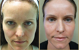 Los Angeles Patient Before and After Fraxel Repair