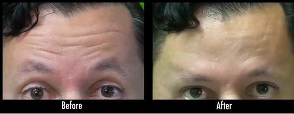 Dysport for Forehead Lines| Male Patient Before and After His Treatment