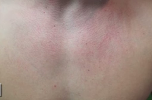 Los Angeles Patient With Chest Rosacea Before Vbeam Laser Treatment