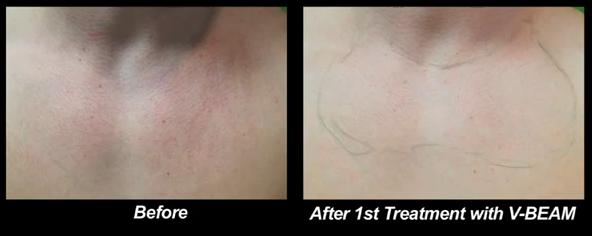 Los Angeles patient before and after treatment of Rosacea with the Vbeam laser