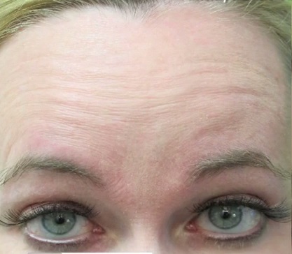 Patient With Forehead Wrinkles Before Botox Treatment