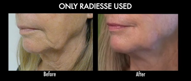 Radiesse| Anti-Aging Filler For Lower Face