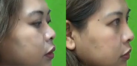 Los Angeles Patient's Non-Surgical Nose Job Results