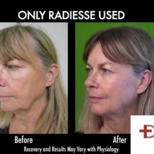 radiesse-jowl-removal-non-surgical