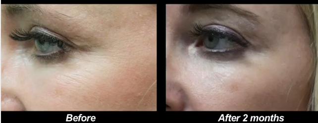 Crows Feet| Treatment With Botox