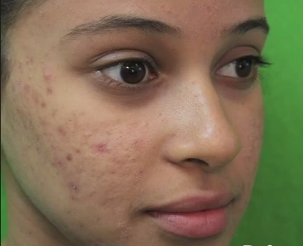 Acne Condition in Young Woman