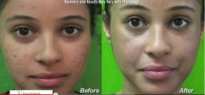 los-angeles-acne-treatment-results-001