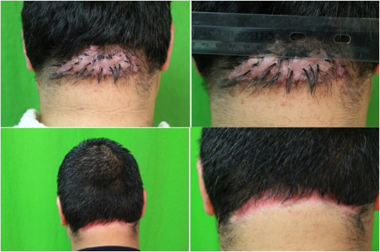 Acne keloidalis nuchae treatment discount