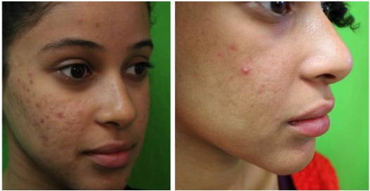 Acne Scar Treatment| Patient's Face - Three Quarter's View Acne Scar Treatment| Patient's Face - Three Quarter's View